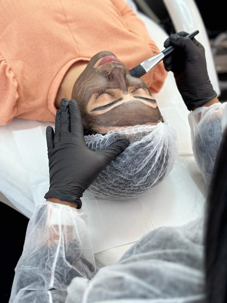 Aplicação da máscara de carbono no rosto para o peeling de Hollywood a laser
