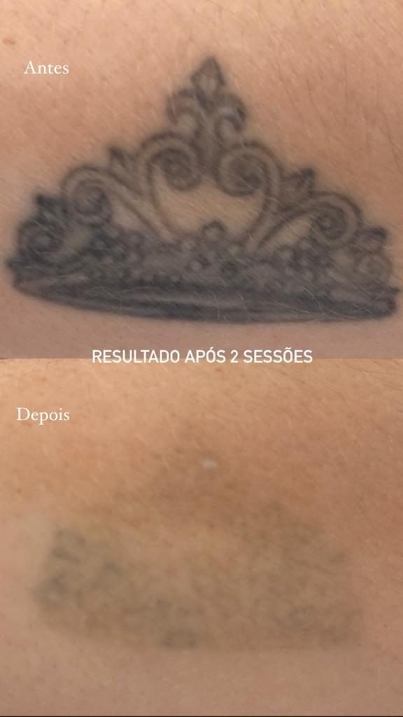 Remoção de tatuagem a laser — resultado após 2 sessões