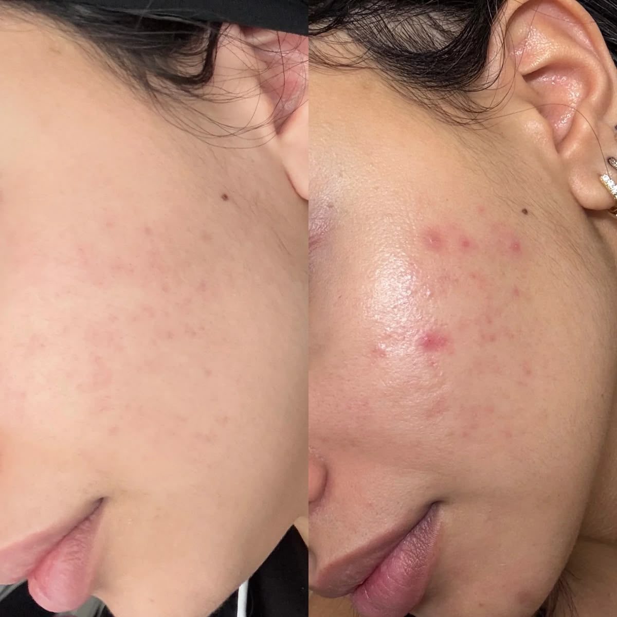 Antes e depois do peeling de Hollywood: poros e oleosidade visivelmente reduzidos