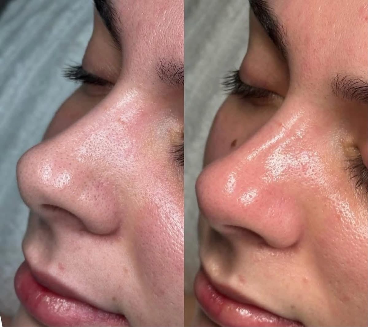 Antes e depois do peeling de Hollywood: pele mais uniforme na região do nariz