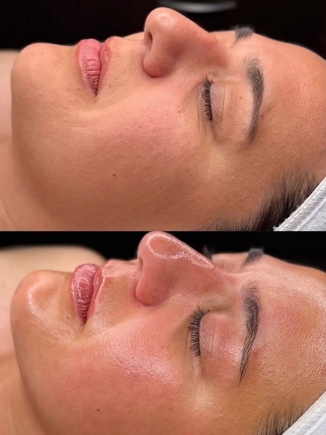 Antes e depois do peeling de Hollywood: viço e luminosidade imediatos na pele