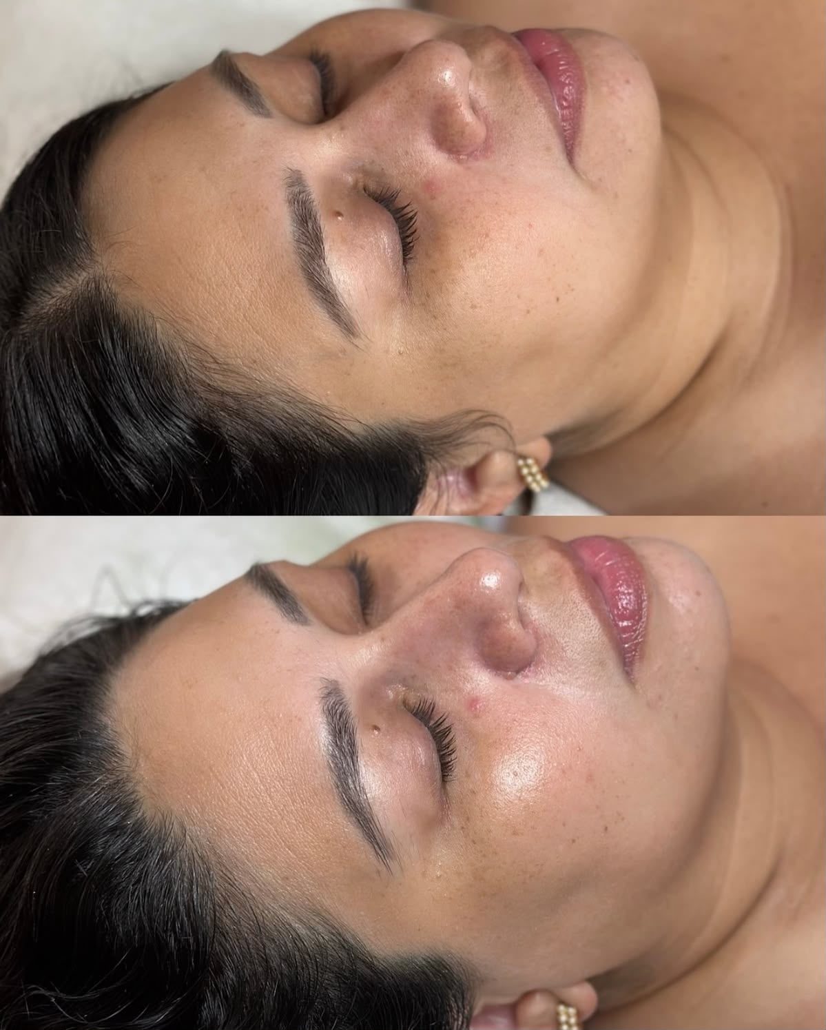 Antes e depois do peeling de Hollywood: tom de pele mais uniforme no rosto todo