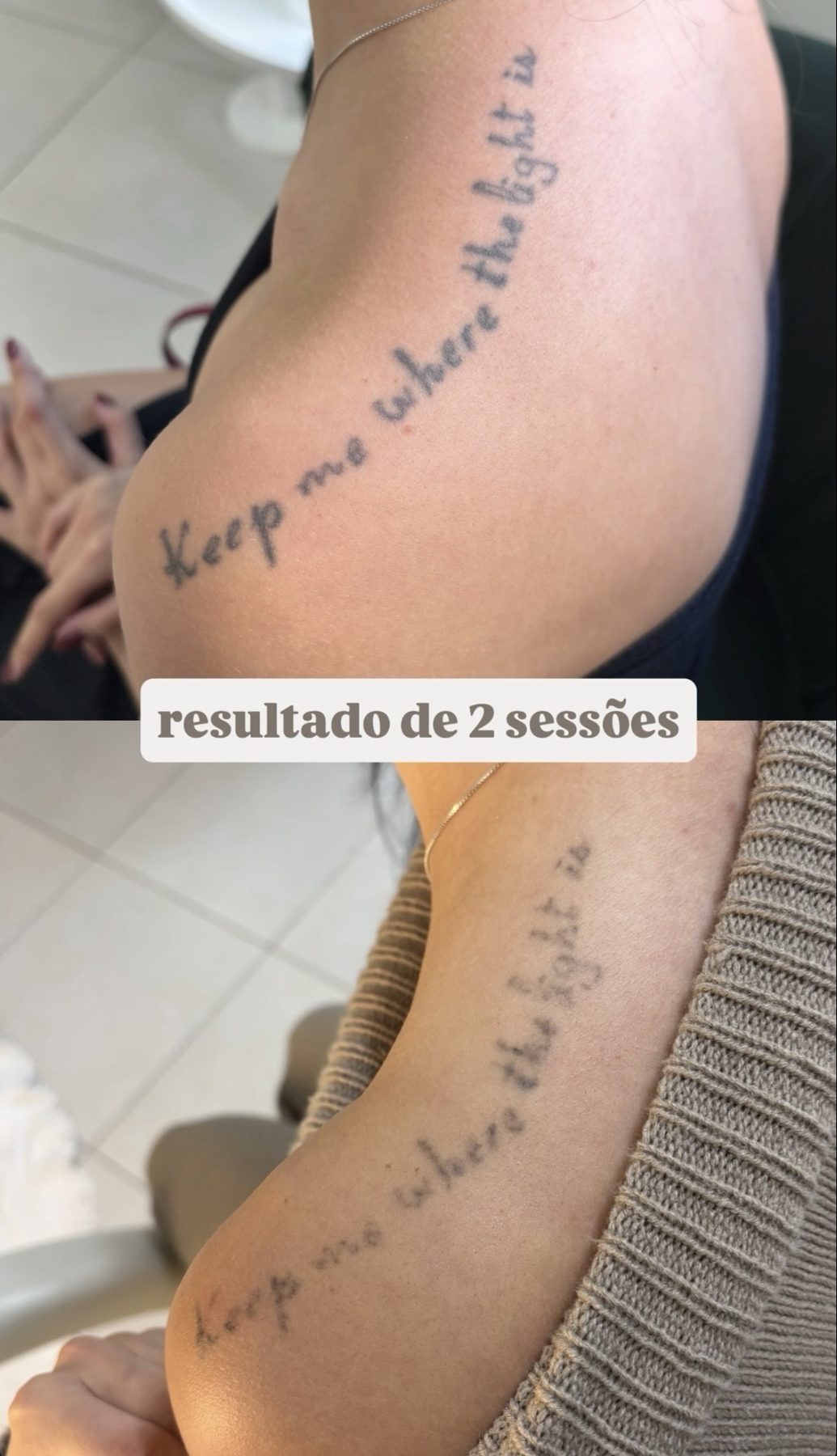 Remoção de tatuagem a laser no braço — resultado após 2 sessões