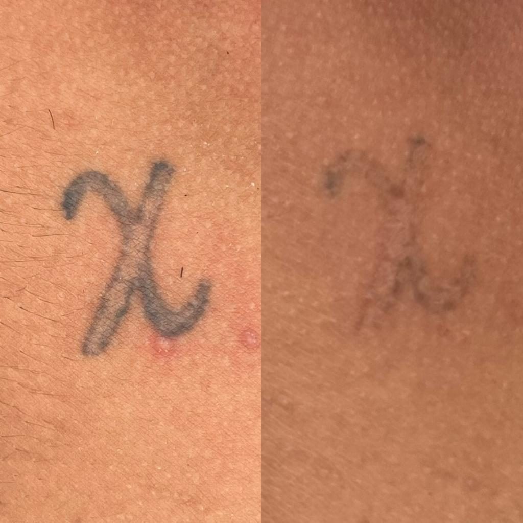 Remoção de tatuagem a laser — antes e depois