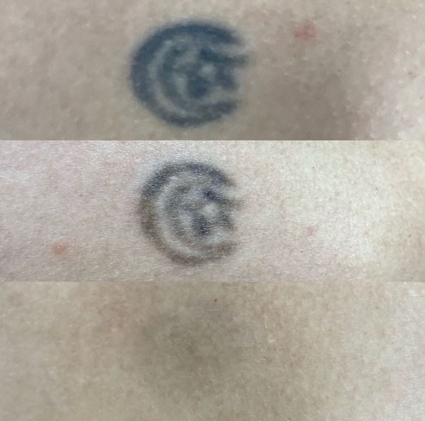 Remoção de tatuagem a laser — evolução em etapas