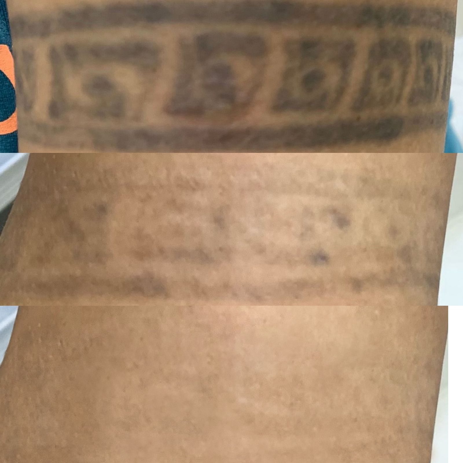 Remoção de tatuagem a laser — evolução em etapas