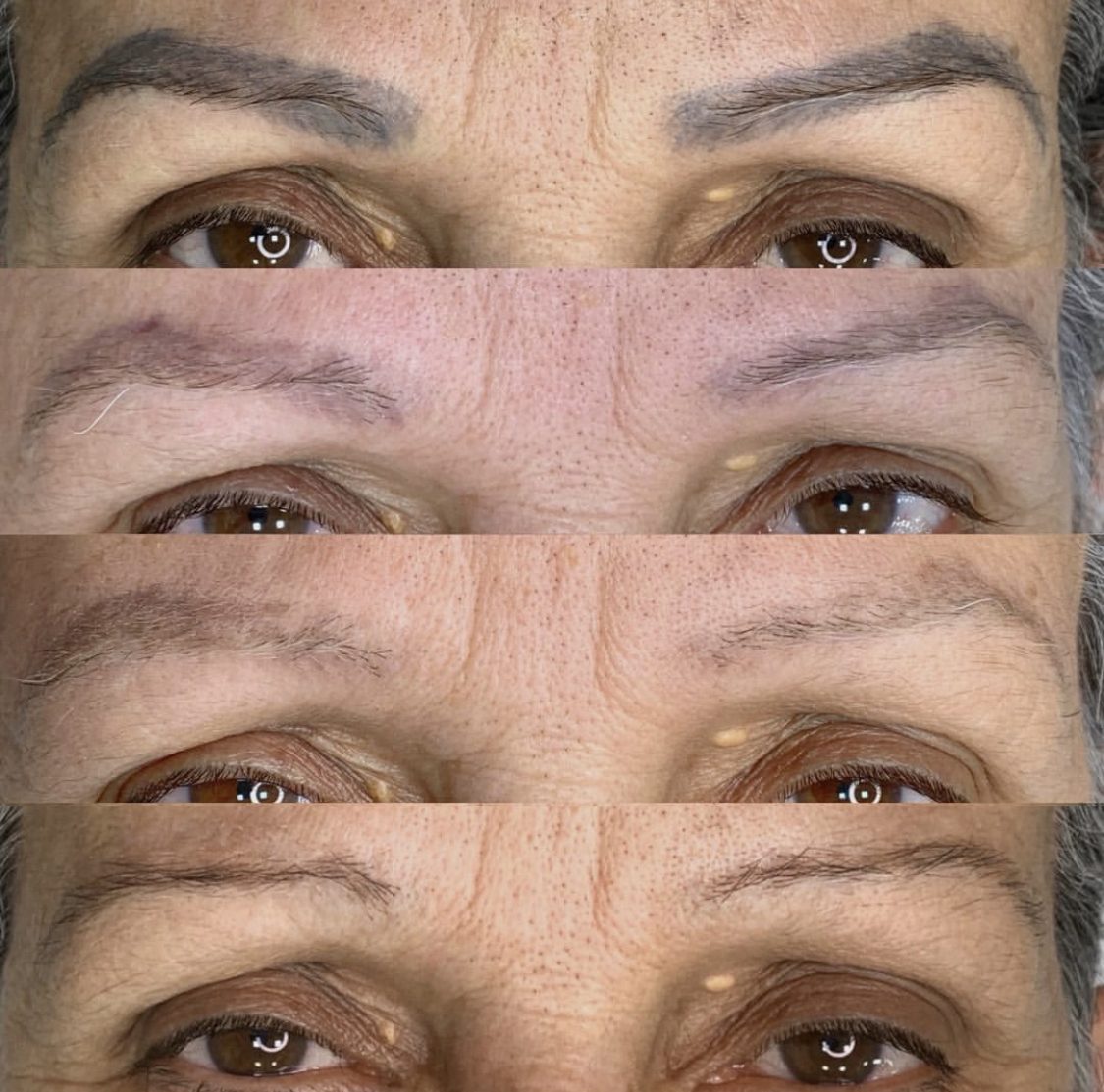 Remoção de micropigmentação de sobrancelha — evolução