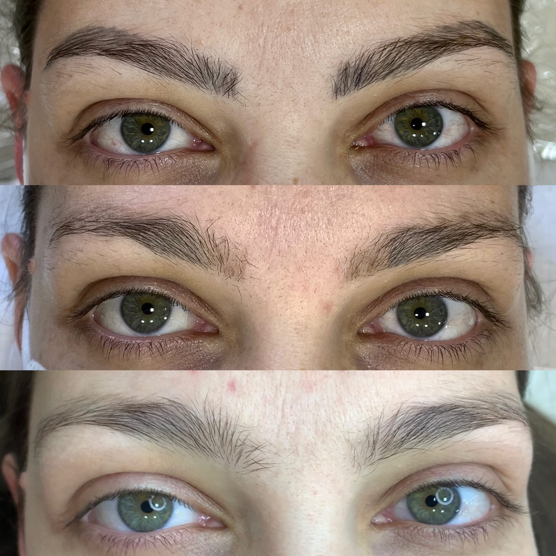 Remoção de micropigmentação de sobrancelha — evolução